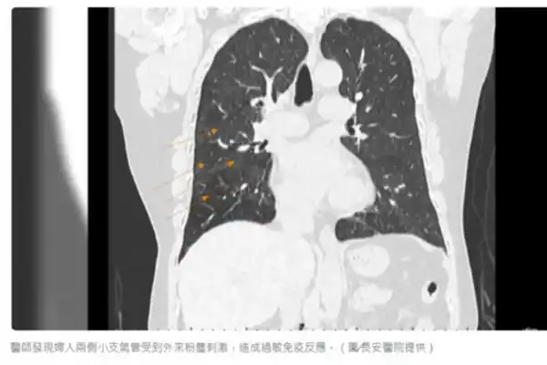 didiagnosis menderita kantung tepung paru-paru setelah terpapar tepung dalam waktu lama.